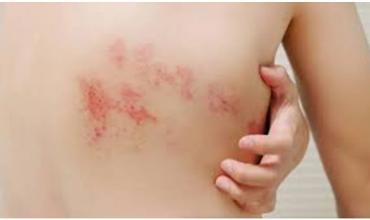 El herpes zóster afecta cada vez a más adultos mayores y genera preocupación médica por sus secuelas