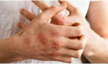 Día Mundial de la Psoriasis: la intervención temprana puede cambiar el curso de esta enfermedad crónica